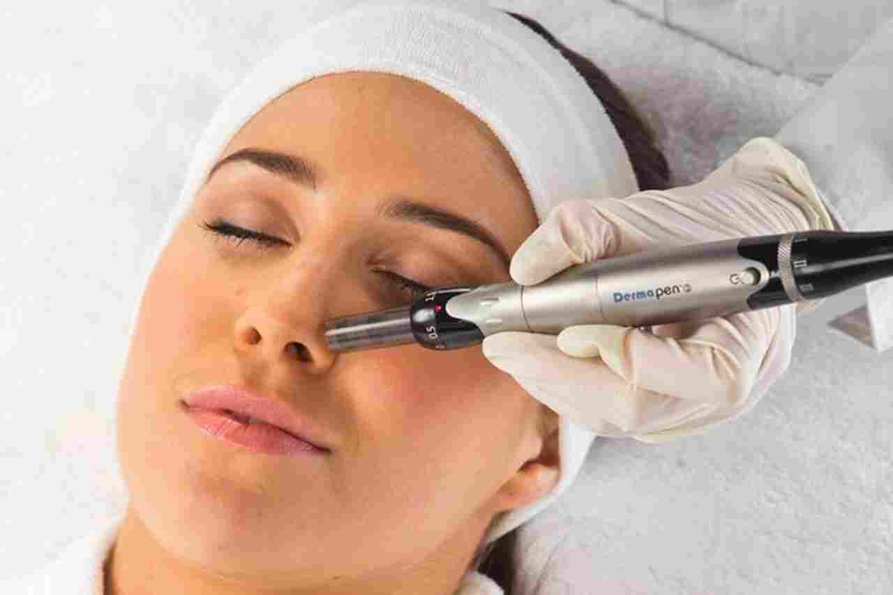 Dermapen-Treatment (1)