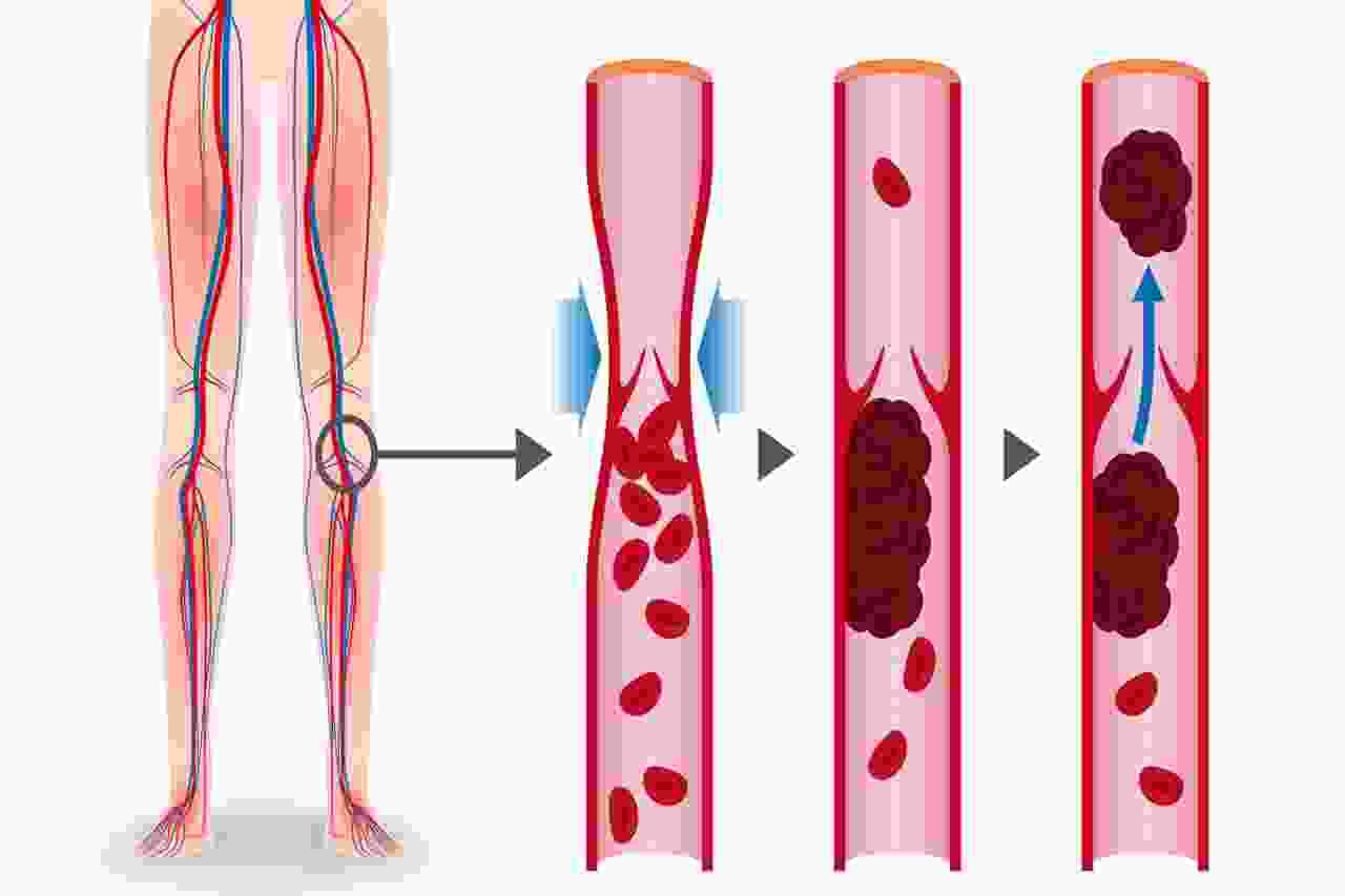 الجلطات الوريدية 1