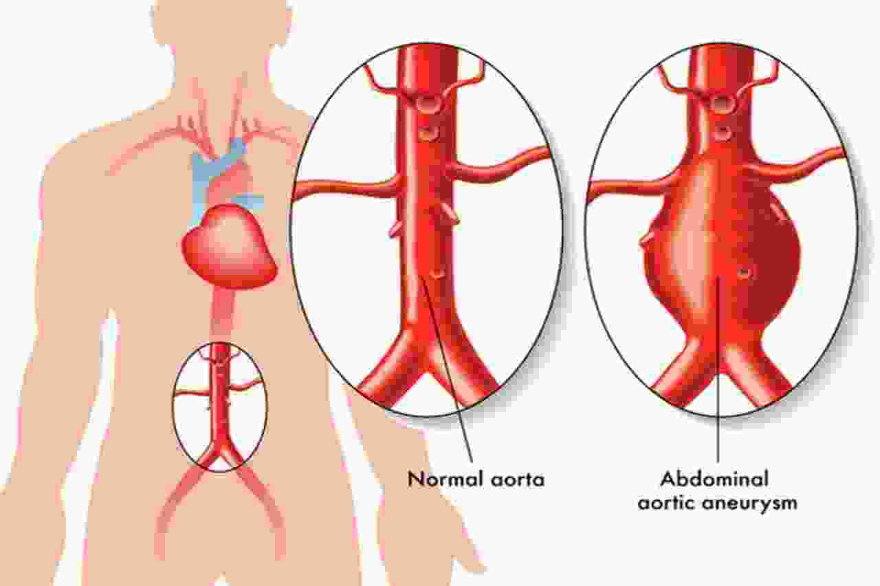 توسع الشريان الابهري 1