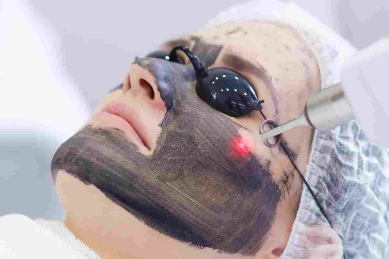 التقشير الكربوني اربد 1